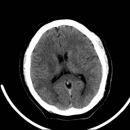 超急性期脑梗死首诊CT表现汇总及典型病例分析 超急性期脑梗死首诊CT表现汇总及典型病例分析