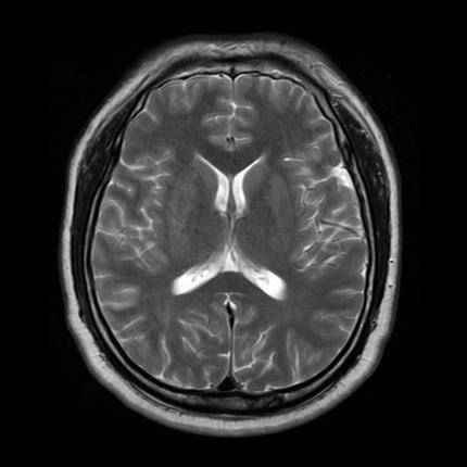 超急性期脑梗死首诊CT表现汇总及典型病例分析 超急性期脑梗死首诊CT表现汇总及典型病例分析