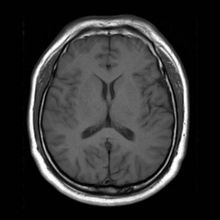 超急性期脑梗死首诊CT表现汇总及典型病例分析 超急性期脑梗死首诊CT表现汇总及典型病例分析