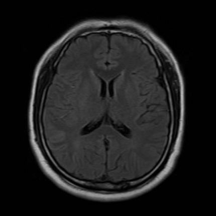 超急性期脑梗死首诊CT表现汇总及典型病例分析 超急性期脑梗死首诊CT表现汇总及典型病例分析