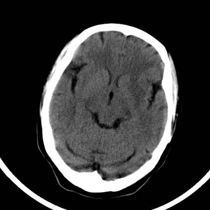 超急性期脑梗死首诊CT表现汇总及典型病例分析 超急性期脑梗死首诊CT表现汇总及典型病例分析