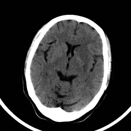 超急性期脑梗死首诊CT表现汇总及典型病例分析 超急性期脑梗死首诊CT表现汇总及典型病例分析