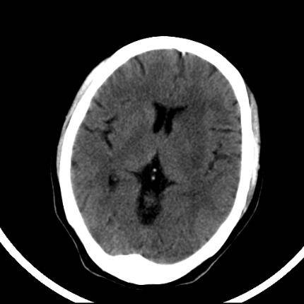 超急性期脑梗死首诊CT表现汇总及典型病例分析 超急性期脑梗死首诊CT表现汇总及典型病例分析