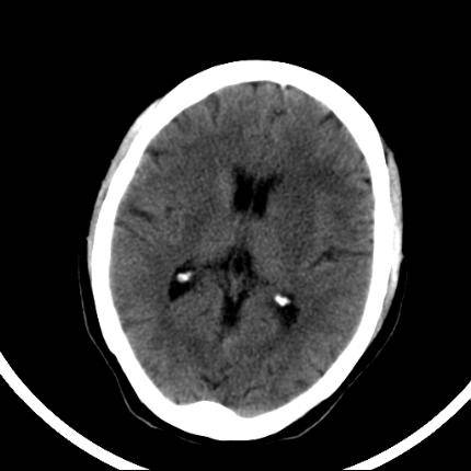 超急性期脑梗死首诊CT表现汇总及典型病例分析 超急性期脑梗死首诊CT表现汇总及典型病例分析
