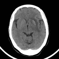 超急性期脑梗死首诊CT表现汇总及典型病例分析 超急性期脑梗死首诊CT表现汇总及典型病例分析