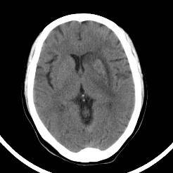 超急性期脑梗死首诊CT表现汇总及典型病例分析 超急性期脑梗死首诊CT表现汇总及典型病例分析