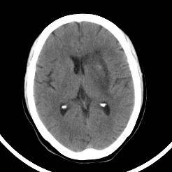 超急性期脑梗死首诊CT表现汇总及典型病例分析 超急性期脑梗死首诊CT表现汇总及典型病例分析