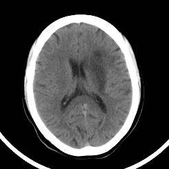 超急性期脑梗死首诊CT表现汇总及典型病例分析 超急性期脑梗死首诊CT表现汇总及典型病例分析