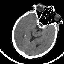 超急性期脑梗死首诊CT表现汇总及典型病例分析 超急性期脑梗死首诊CT表现汇总及典型病例分析