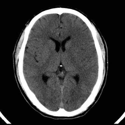 超急性期脑梗死首诊CT表现汇总及典型病例分析 超急性期脑梗死首诊CT表现汇总及典型病例分析