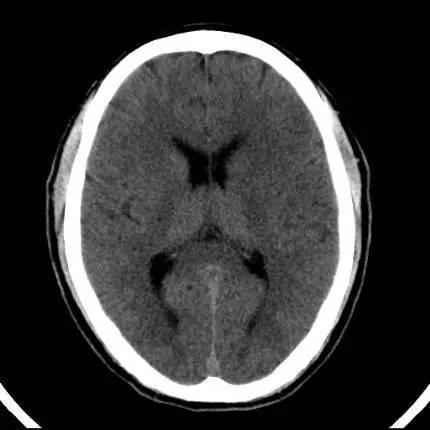 超急性期脑梗死首诊CT表现汇总及典型病例分析 超急性期脑梗死首诊CT表现汇总及典型病例分析