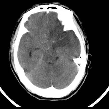 超急性期脑梗死首诊CT表现汇总及典型病例分析 超急性期脑梗死首诊CT表现汇总及典型病例分析