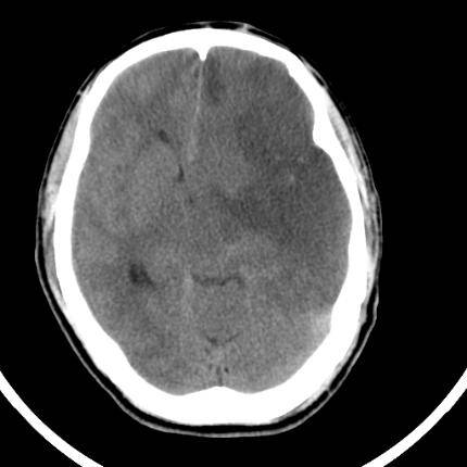 超急性期脑梗死首诊CT表现汇总及典型病例分析 超急性期脑梗死首诊CT表现汇总及典型病例分析