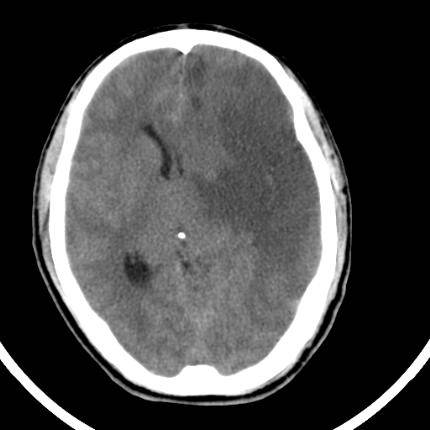 超急性期脑梗死首诊CT表现汇总及典型病例分析 超急性期脑梗死首诊CT表现汇总及典型病例分析