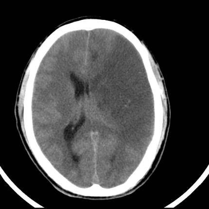 超急性期脑梗死首诊CT表现汇总及典型病例分析 超急性期脑梗死首诊CT表现汇总及典型病例分析