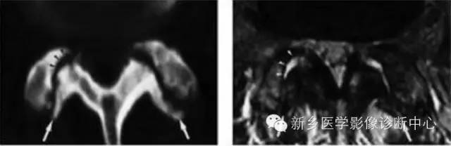 椎小关节紊乱综合征的影像分级