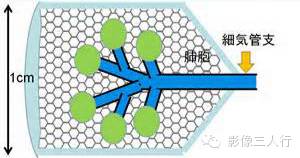 肺内结节性病变的分析过程 肺内结节性病变的分析过程