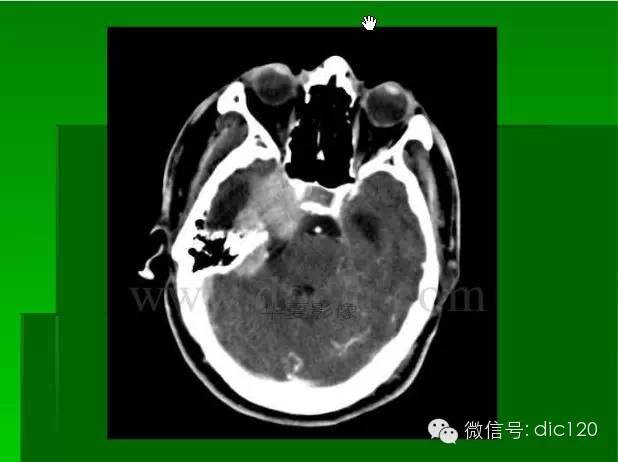【PPT】颅内钙化影像学诊断原则和常见原因