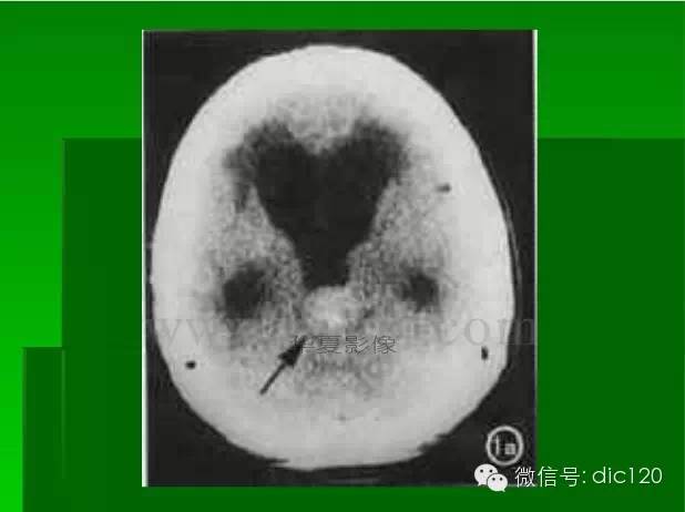 【PPT】颅内钙化影像学诊断原则和常见原因