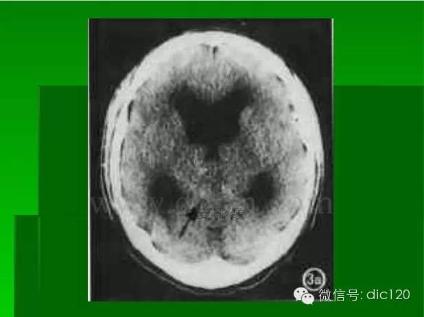 【PPT】颅内钙化影像学诊断原则和常见原因