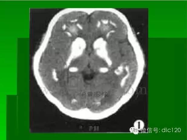 【PPT】颅内钙化影像学诊断原则和常见原因
