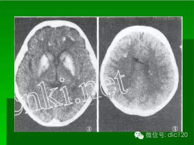【PPT】颅内钙化影像学诊断原则和常见原因