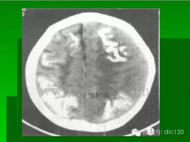 【PPT】颅内钙化影像学诊断原则和常见原因