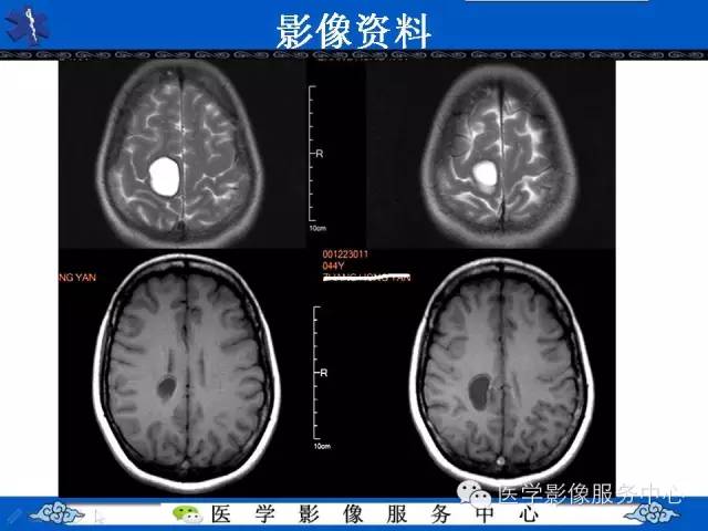 【病例】节细胞胶质瘤1例MR影像表现