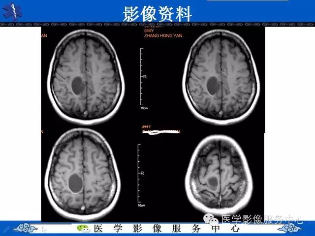 【病例】节细胞胶质瘤1例MR影像表现