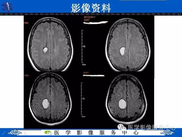 【病例】节细胞胶质瘤1例MR影像表现