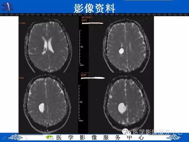 【病例】节细胞胶质瘤1例MR影像表现