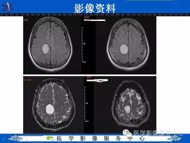 【病例】节细胞胶质瘤1例MR影像表现