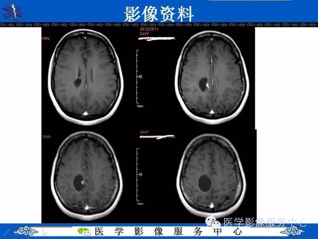 【病例】节细胞胶质瘤1例MR影像表现