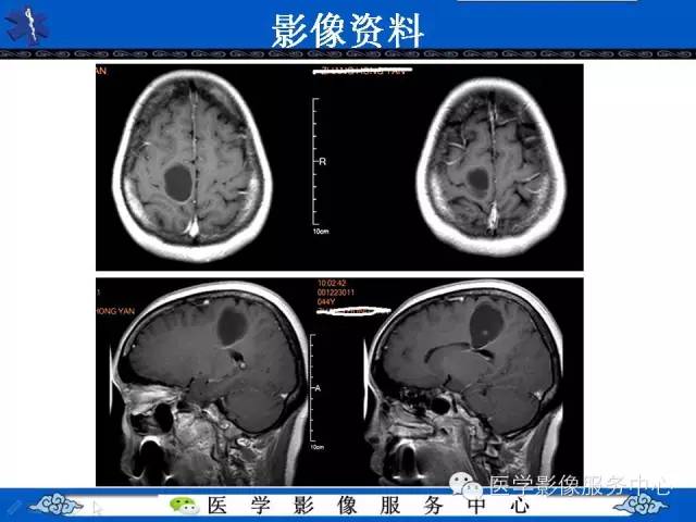 【病例】节细胞胶质瘤1例MR影像表现
