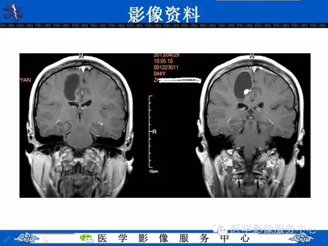 【病例】节细胞胶质瘤1例MR影像表现