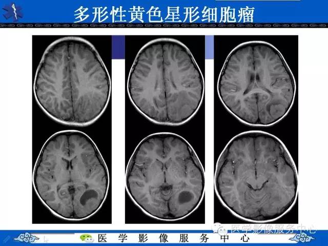 【病例】节细胞胶质瘤1例MR影像表现