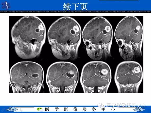 【病例】节细胞胶质瘤1例MR影像表现
