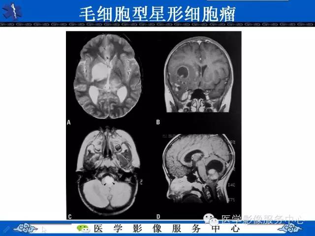 【病例】节细胞胶质瘤1例MR影像表现