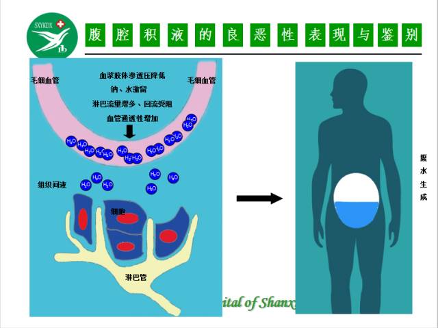 【PPT】腹腔积液的良恶性表现与鉴别