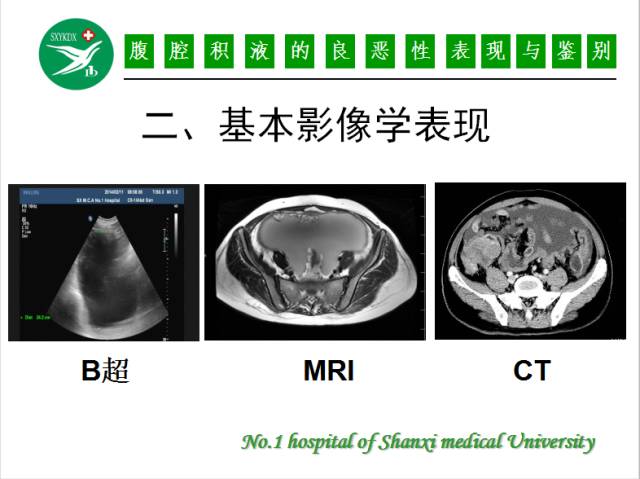 【PPT】腹腔积液的良恶性表现与鉴别