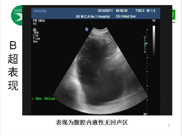 【PPT】腹腔积液的良恶性表现与鉴别