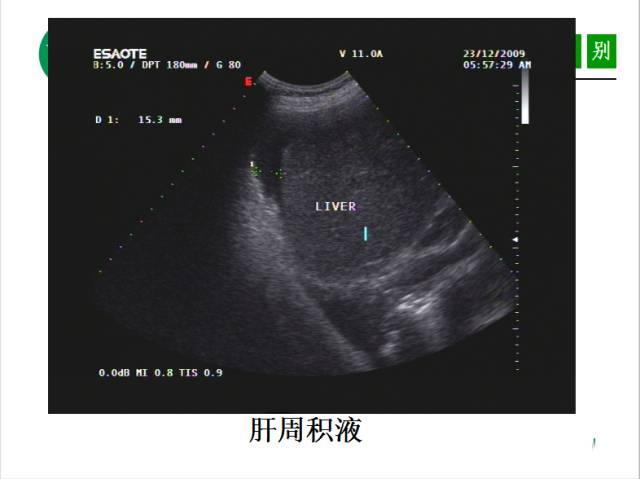 【PPT】腹腔积液的良恶性表现与鉴别