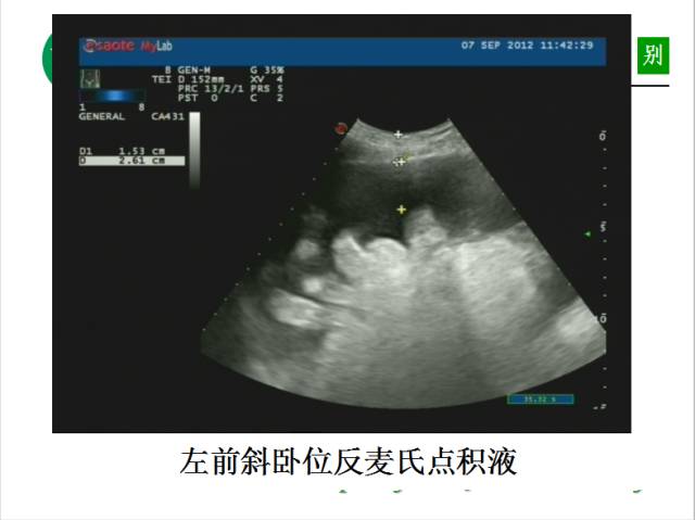 【PPT】腹腔积液的良恶性表现与鉴别