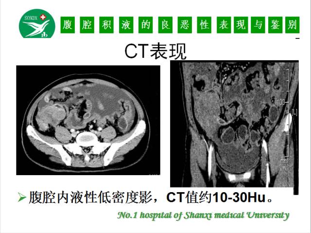 【PPT】腹腔积液的良恶性表现与鉴别