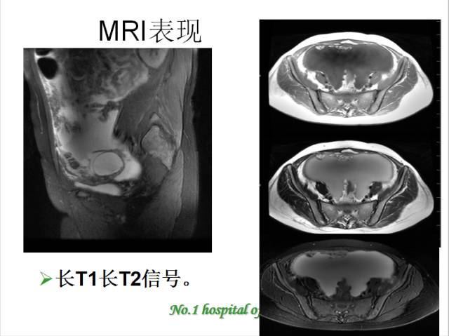 【PPT】腹腔积液的良恶性表现与鉴别