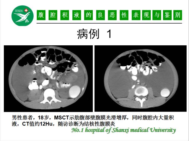 【PPT】腹腔积液的良恶性表现与鉴别