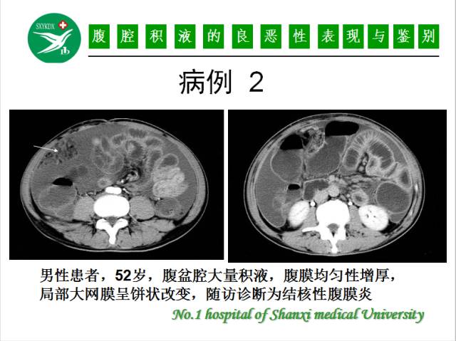 【PPT】腹腔积液的良恶性表现与鉴别