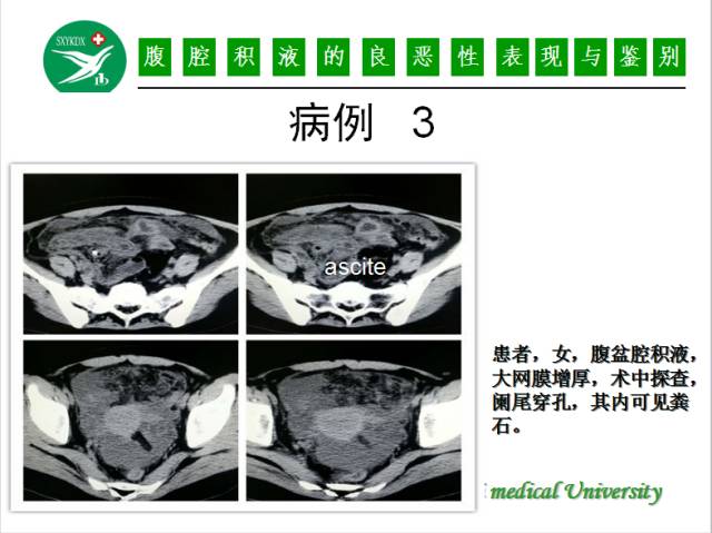 【PPT】腹腔积液的良恶性表现与鉴别