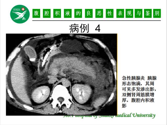 【PPT】腹腔积液的良恶性表现与鉴别