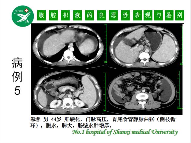 【PPT】腹腔积液的良恶性表现与鉴别
